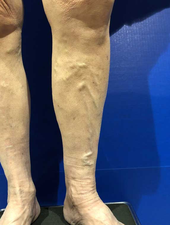 Varicose Veins